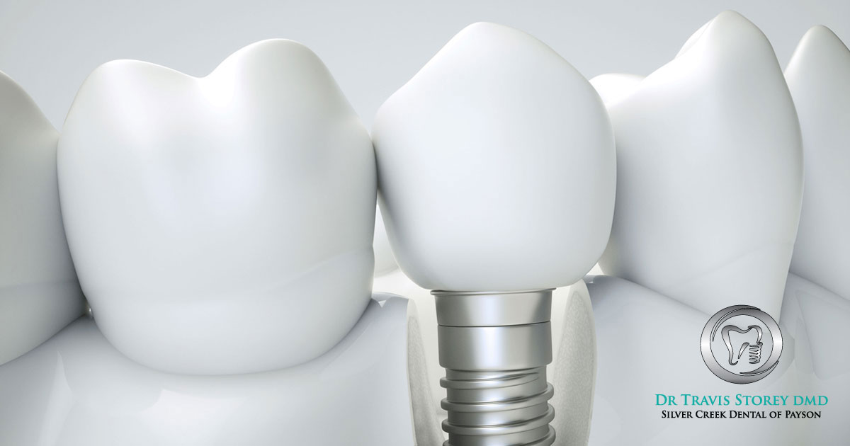 Dental Implants Silver Creek Dental Payson, Utah