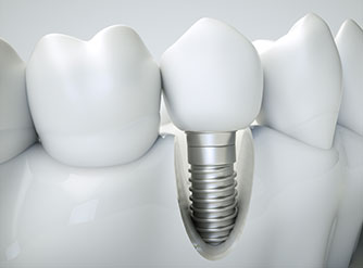 teeth-implants