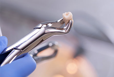 Dental extractions at Silver Creek Dental