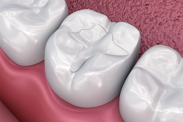 Image of a white dental filling